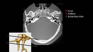 5 Petrous bone Imaging  part I  ProfMamdouh mahfouz 2019 edition [upl. by Nims]