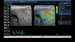 IQ 310 LIVER HEPATOMA ULTRASOUND ECHOPAC ANALYSIS ELASTOGRAPHY [upl. by Kalinda]