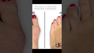 Revolutionary Bunion Surgery A GameChanger for Foot Pain Relief [upl. by Carlin]