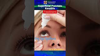 Superficial Punctate Keratitis Treatment [upl. by Saidel]