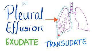 Pleural Effusion  Transudate or Exudate  Causes and Liddle’s Criteria Pulmonary Medicine Playlist [upl. by Naesar736]