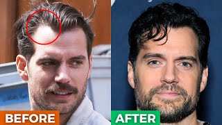 5 BRILLIANT Hairstyles To HIDE A Receding HairlineWidows Peak [upl. by Augustine46]