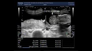 Ultrasound Video showing Cystic hygroma with Microcephaly [upl. by Duile]