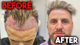 My Hair Transplant Journey in Turkey  Before and After  HairCenterOfTurkey [upl. by Howlan]