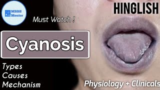 Cyanosis  Types Causes amp Mechanism  Physiology  Clinicals  MBBS Mentor [upl. by Fleisig]