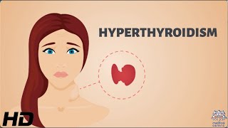 HYPERTHYROIDISM Everything You Need To Know [upl. by Iblehs]