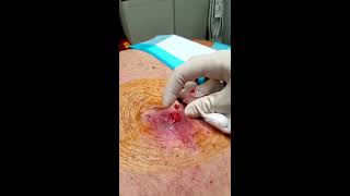 HD Graphic Step by Step Abscess and Infected Lipoma Drainage Medical Education amp Training [upl. by Stich]