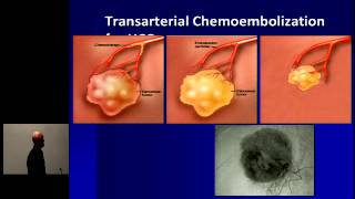 Hepatocellular Carcinoma Optimal Treatment and Transplantation [upl. by Letnom209]