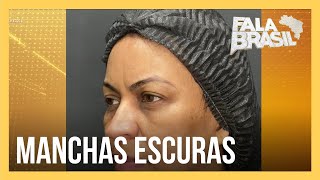 Pesquisa revela tratamento eficaz para melasma após 17 anos de estudo [upl. by Samy95]