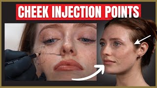 The Best Cheek Filler Injection Points  Where to inject the cheek for beautiful results [upl. by Chessa]