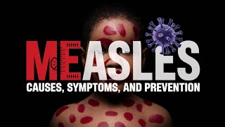 Measles symptoms prevention amp treatment [upl. by Naresh14]