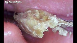 Ear Wax Removal 93 Big And Thick Earwax Causes Itching  Ear Cleaning ASMR Video Relaxing [upl. by Lemon]