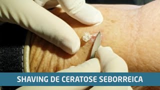 Ceratose Seborreica  Ep 02 Remoção por shaving [upl. by Calvano]