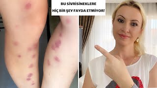 Sivrisinek Kabusu Bir Gecede 54 Isırık😲 Sonrası İçin Ne Yapmalısınız [upl. by Florinda]