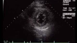 The Relationship of Regional Wall Segments and Cornary Artery Perfusion [upl. by Auqinet]