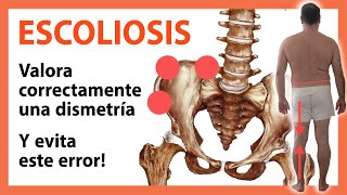 Mejora los Resultados del Tratamiento de la Escoliosis Importancia de la Evaluación de la Dismetría [upl. by Timi]