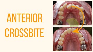 FIXING Anterior Crossbite  Occlusal View  Shorts [upl. by Desi770]