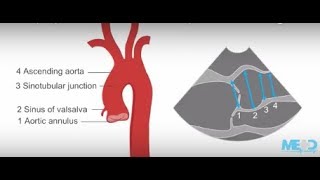 How to identify a thoracic aortic aneurysm using ultrasound [upl. by Gary]