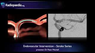 Stroke Endovascular management of ischaemic stroke  radiology video tutorial [upl. by Aihsema]