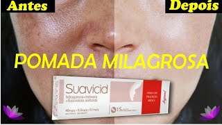 SUAVICID TUDO SOBRE A POMADA MILAGROSA PARA MANCHAS e MELASMA  SUAVICID ANTES E DEPOIS [upl. by Paulina]