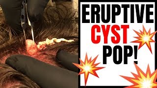 ERUPTIVE CYST POP [upl. by Kaleena549]