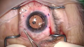 multifocal IOL fixation 2 [upl. by Regazzi]