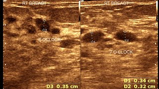 Duct ectasia breast  Axilla Enlarge Lymph Node [upl. by Okorih]