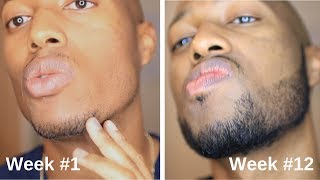 Minoxidil Beard Journey 3 Month Transformation [upl. by Rodney]