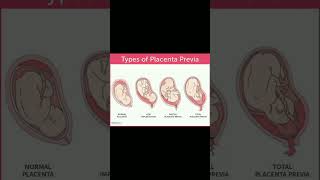 Types of placenta previa implantation  bleeding 🩸knowledge medical shortvideo share [upl. by Clercq]