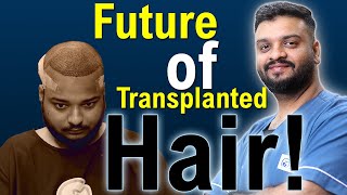 Will Transplanted HAIR fall out AFTER few years  Will they GROW BACK  Dr Vivek Galani  RQC [upl. by Nwahsat781]