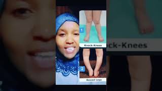 How to say knockknees and bowed legs in Swahili learnswahili swahili [upl. by Assyl]