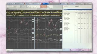 Evoked Potentials  SEP Tibial Nerve [upl. by Vidovik]