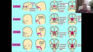 Choanal Atresia part1 [upl. by Rebm]