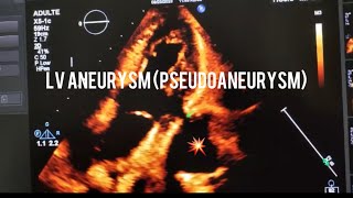 LV ANEURYSMPSEUDO ANEURYSManeurysm atrialseptum cardio echocardiography heartdiseasebaby [upl. by Okika]