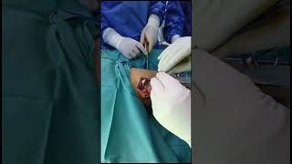 Osteochondroma excision ازالة اورام عظمية من الفخذ و الساق [upl. by Eissej]