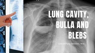 Cavity bulla blebs abscess in a Chest Xray How to differentiate [upl. by Ayle948]