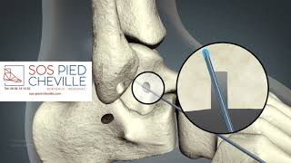 Ligamentoplastie de reconstruction [upl. by Hyde607]