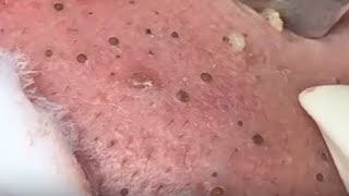 SUPER GIANT BLACKHEAD is here Oddly Video Face Skin with Calm Music [upl. by Maynard]