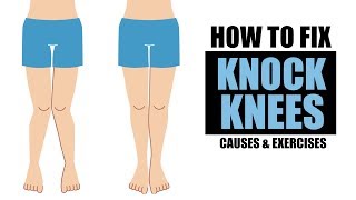 KNOCK KNEE PROBLEM  How to Fix  Info by Guru Mann [upl. by Annawt]