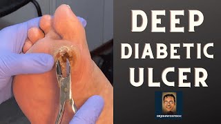 DEEP Diabetic Foot Ulcer podiatristfoot and ankle specialist treats a foot ulcer [upl. by Einahpats396]