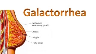 Galactorrhea [upl. by Cyrille642]