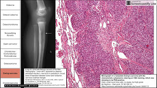 Bone and cartilage tumors [upl. by Adeehsar]