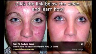 Watch Bio Oil Acne Scars Before amp After Results  Bio Oil Acne Scars Before And After [upl. by Agata]