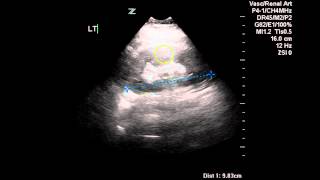 Normal Renal Arterial Doppler  Case Study [upl. by Park569]