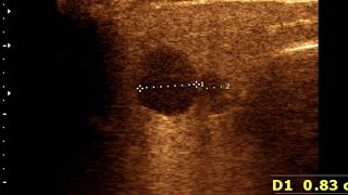 Parotitis  Lymphadenitis  Normal Thyroid Gland [upl. by Faulkner]