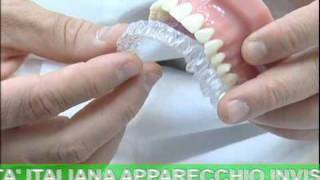 ODONTOIATRIA Invisalign  Apparecchio Invisibile [upl. by Wolfort]