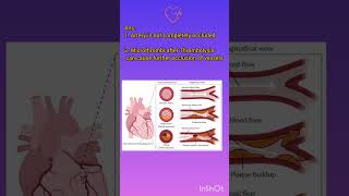 Why is Thrombolysis Contraindicated in STEMI myocardialinfarction myocarditis [upl. by Merwin422]