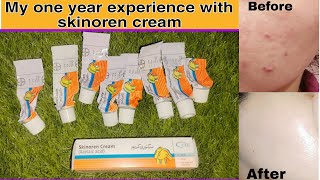 Skinoren creamSkinoren cream reviewsAzalic acid before and after [upl. by Bobbee945]