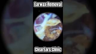 How to get wax out of your ear 01 ear wax removal  ear cleaning  ASMR  relaxation  relax [upl. by Jorgenson564]