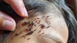 How to Get Rid of Lice Effective Lice Treatment in 3 Steps [upl. by Stedmann]